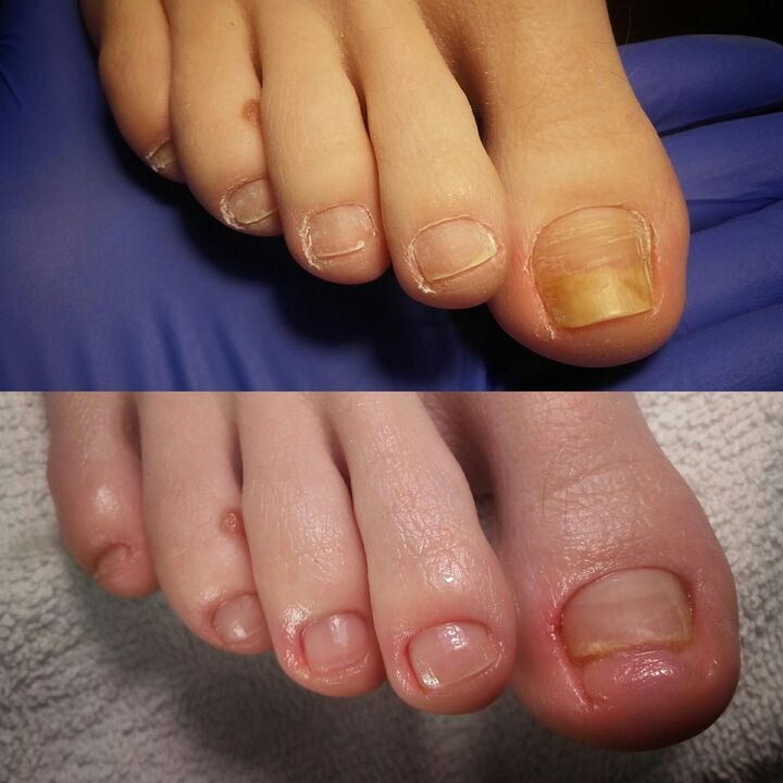 Antes e despois de aplicar a crema Marn Exodermin RAND de Yesenia