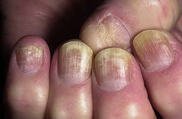 unhas infectadas con fungos Candida