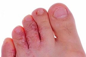 fungo nos dedos dos pés